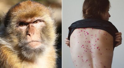 منظمة الصحة : لا خوف حاليا من تحول جدري القرود إلى جائحة