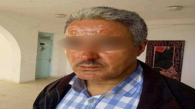 اصابة قيم بحروق في المدرسة الاعدادية بالسبيخة بعد انقاذه لـ31 تلميذا 
